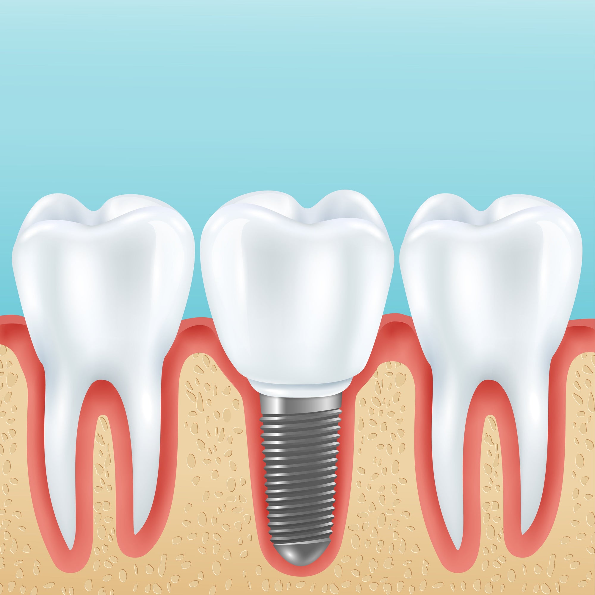 How to Care for Dental Implants