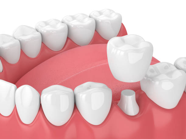How to Care for Caps and Crowns